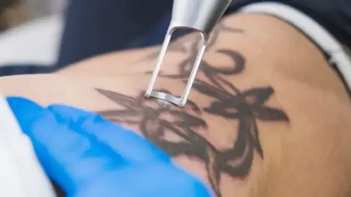Tatto Removal
